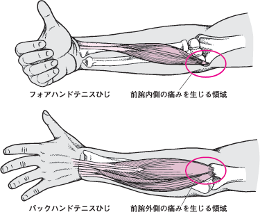 テニス肘